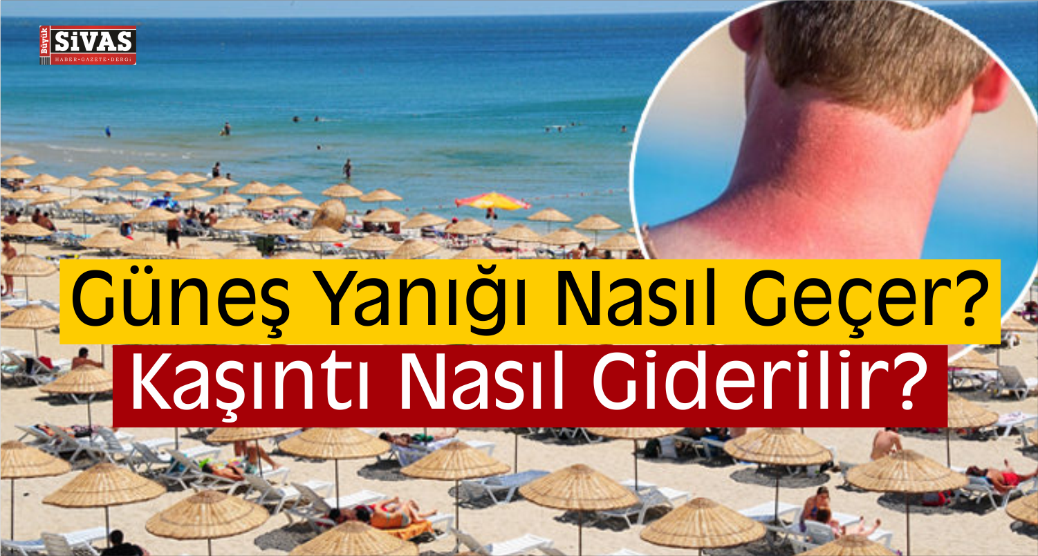 Güneş Yanığı Nasıl Geçer?