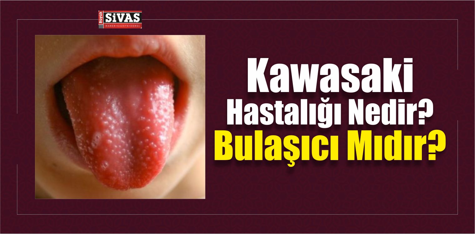 Kawasaki Hastalığı