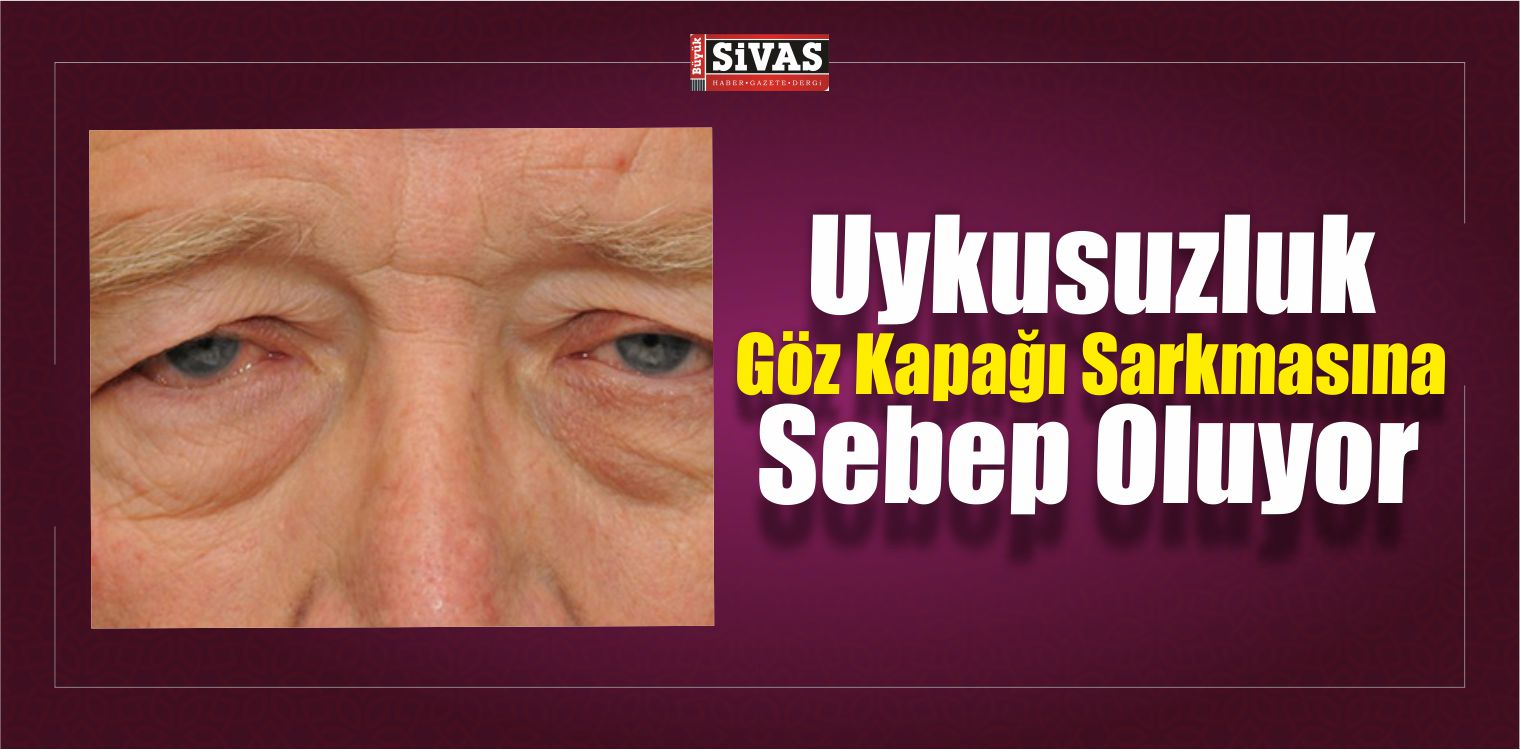 Göz Kapağı Sarkması