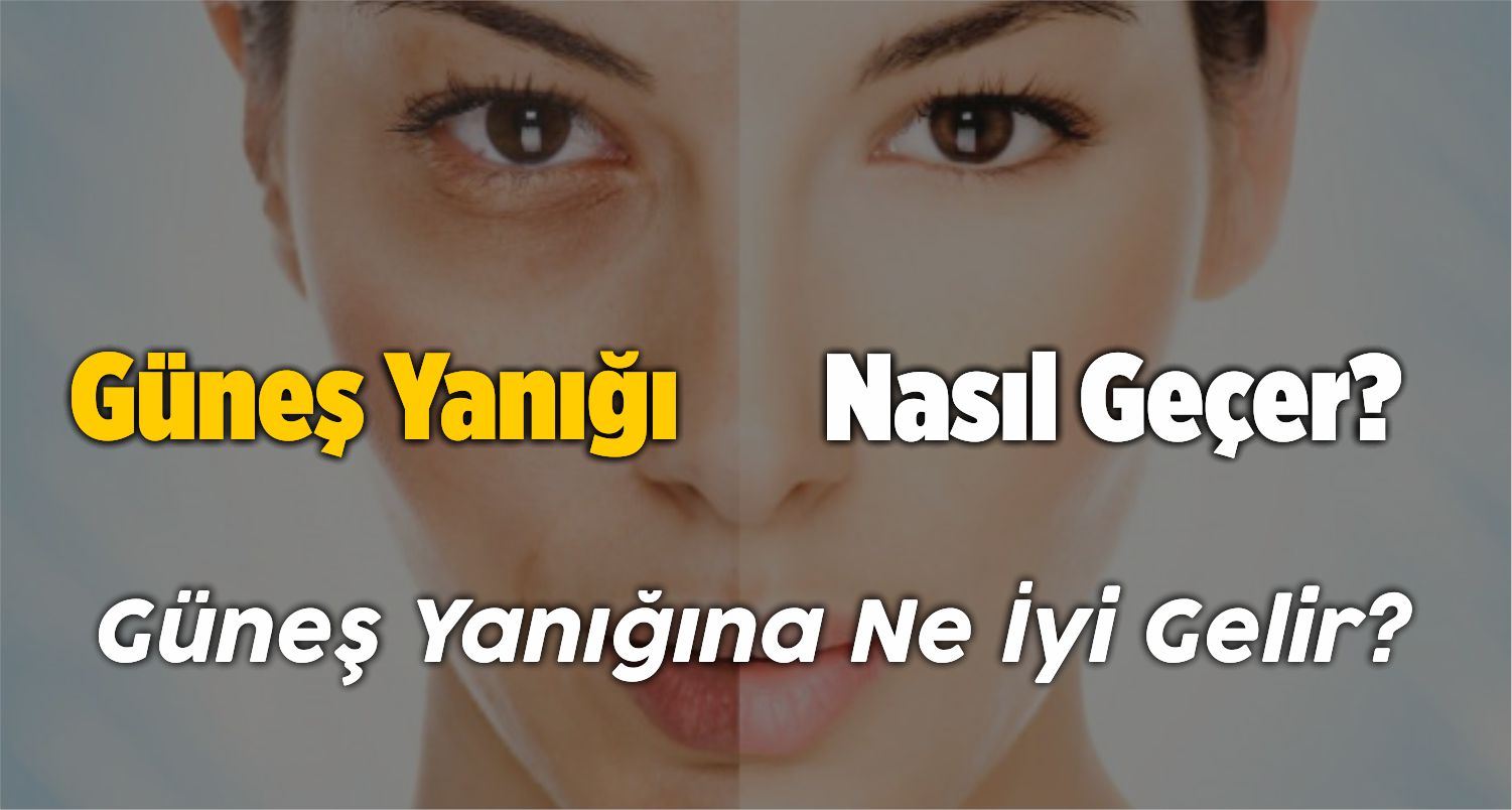 Güneş Yanığı Nasıl Geçer? Güneş Yanığına Ne İyi Gelir? Tedavi Yöntemi!