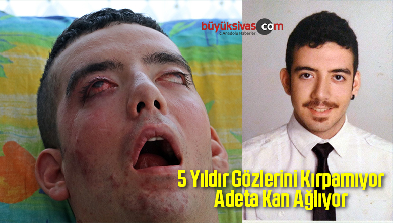 5 Yıldır Gözlerini Kırpamıyor Adeta Kan Ağlıyor
