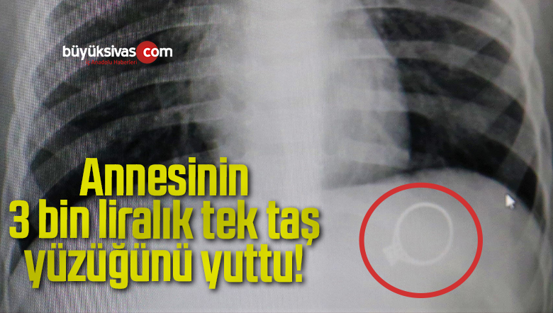 Annesinin 3 bin liralık tek taş yüzüğünü yuttu