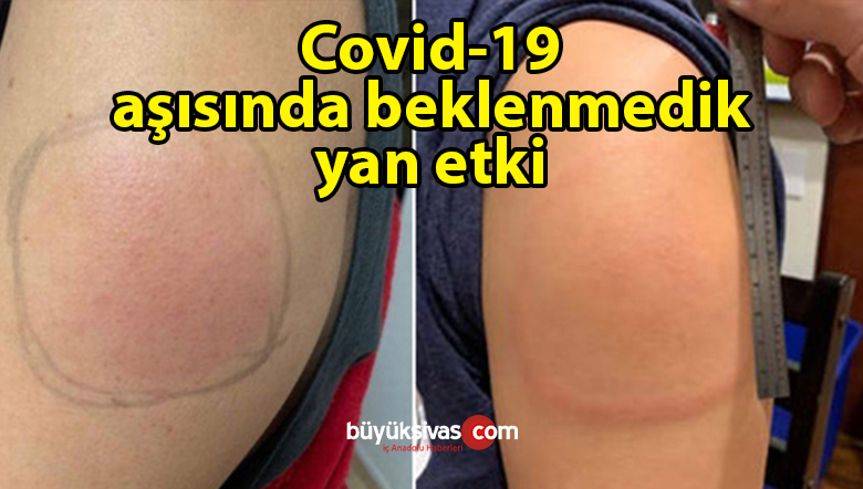 Moderna aşısı yaptıran kişilerde görülen yan etki işte ‘covid-19 kolu’