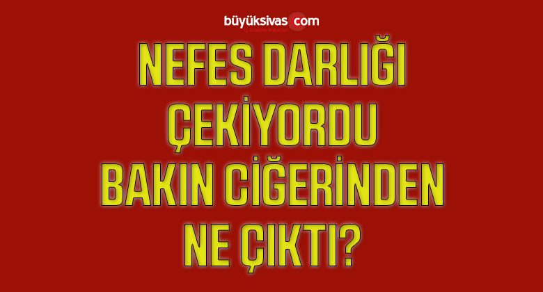 Nefes Darlığı ve Şiddetli Ağrı Çeken Hastanın Ciğerinden Arnavut Biberi Çıktı