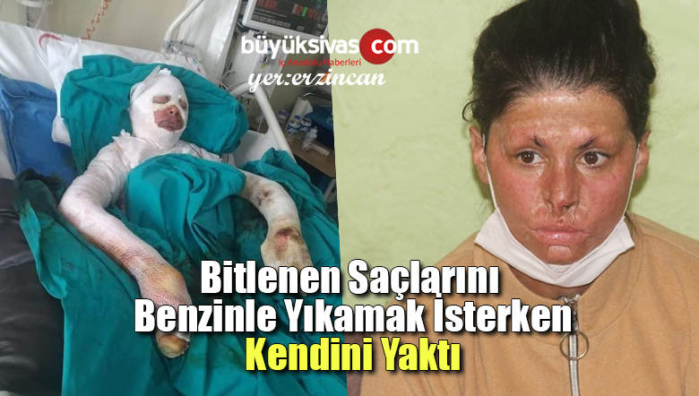 Saçlarını Benzinle Yıkarken Kendini Yaktı! Tedavi Olmak İstiyor