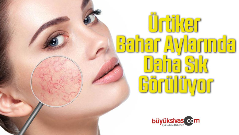 Ürtiker Bahar Aylarında Daha Sık Görülüyor