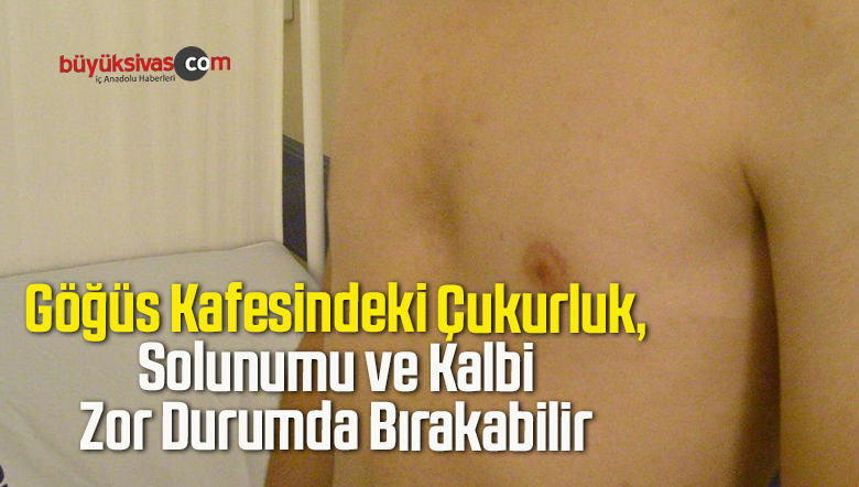 Göğüs Kafesindeki Çukurluk, Solunumu ve Kalbi Zor Durumda Bırakabilir