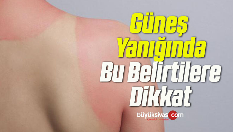 güneş yanığında