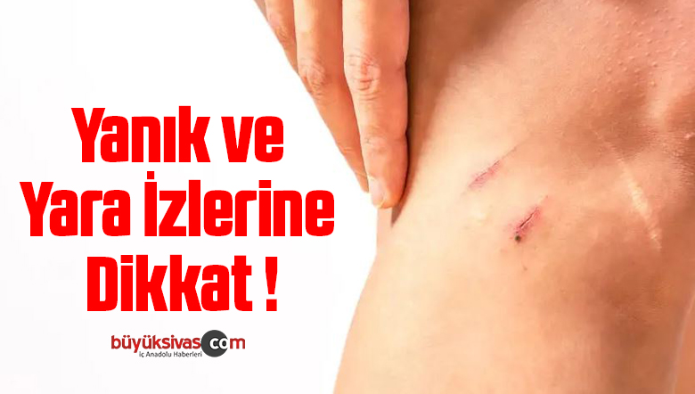 Yanık ve Yara İzlerine Dikkat !