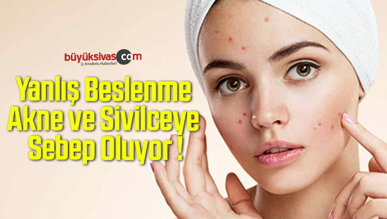 Yanlış Beslenme Akne ve Sivilceye Sebep Oluyor !