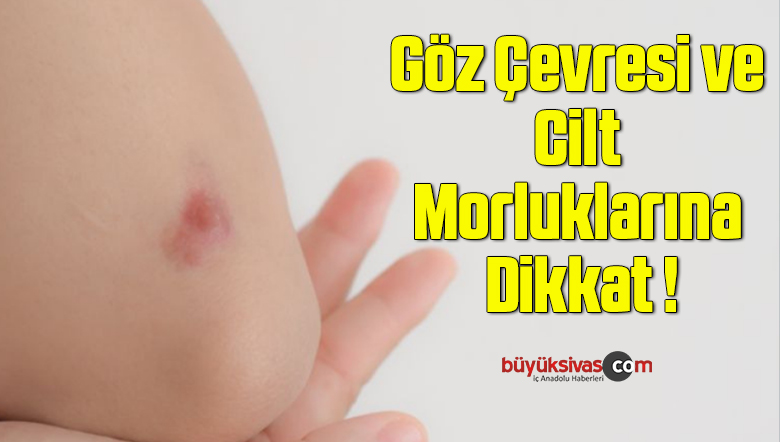 Göz Çevresi ve Cilt Morluklarına Dikkat !