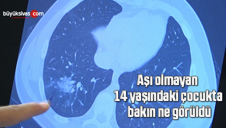 Aşı olmayan 14 yaşındaki çocukta ciddi akciğer tutulumları görüldü