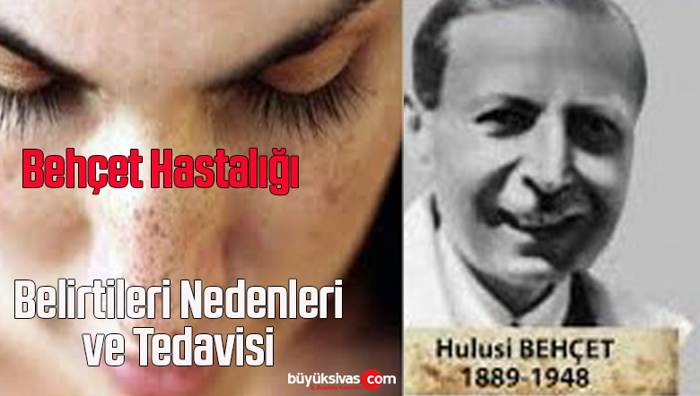 Behçet Hastalığı: Belirtileri, Nedenleri ve Tedavisi