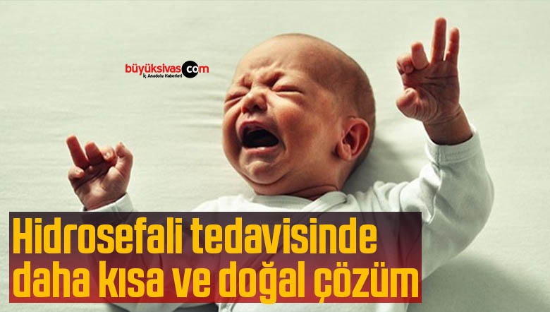 hidrosefali