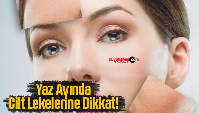 cilt lekeleri