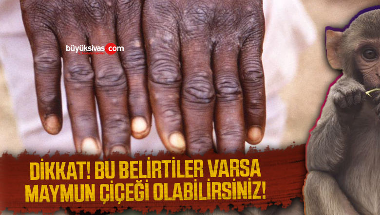 Dikkat! Bu belirtiler varsa Maymun Çiçeği olabilirsiniz