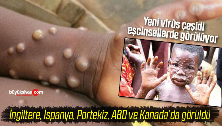 Yeni baş belası maymun çiçeği virüsü! Şimdilik 5 ülkede görüldü