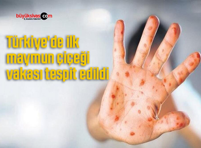 Türkiye’de ilk maymun çiçeği vakası tespit edildi