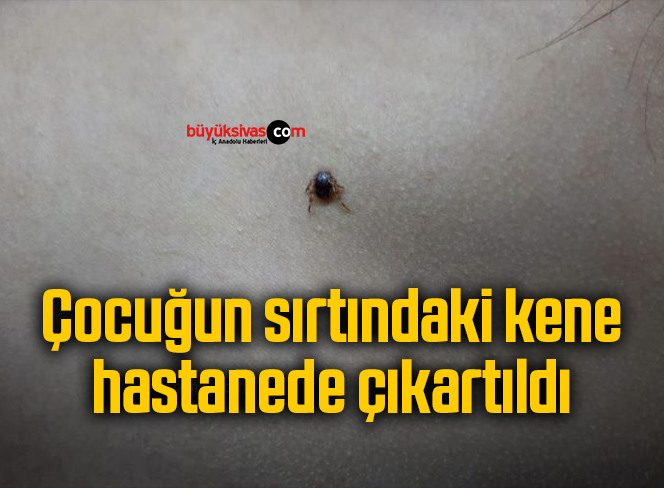 Çocuğun sırtındaki kene hastanede çıkartıldı