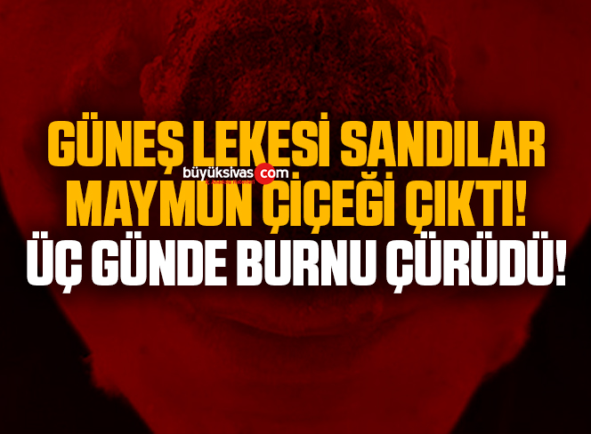 Güneş lekesi sandılar, maymun çiçeği çıktı! Üç günde burnu çürüdü!