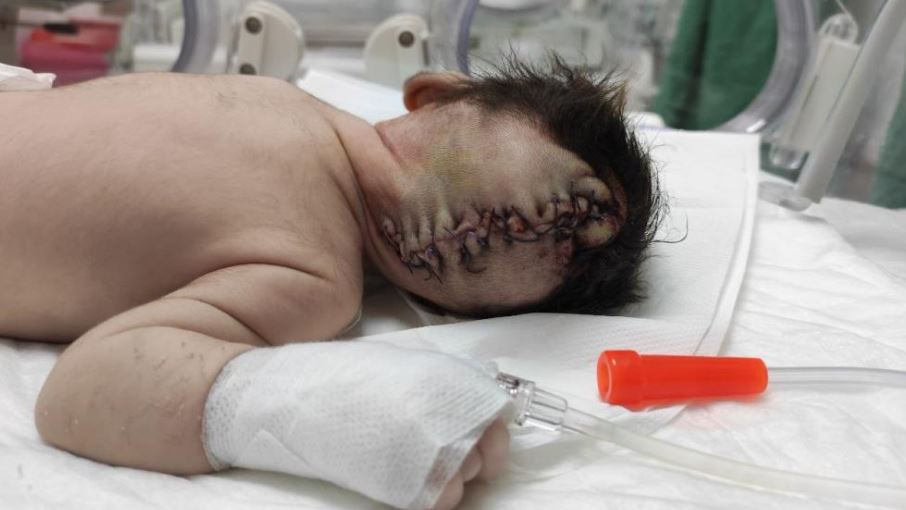 Beyninin yarısı kafatası dışında dünyaya geldi