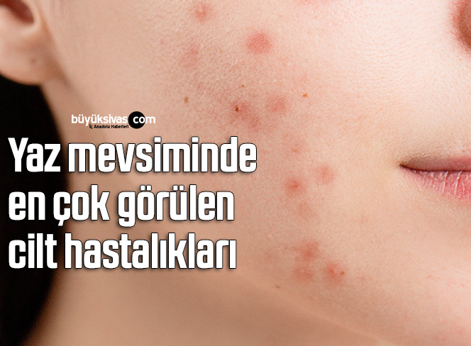 Yaz mevsiminde en çok görülen cilt hastalıkları