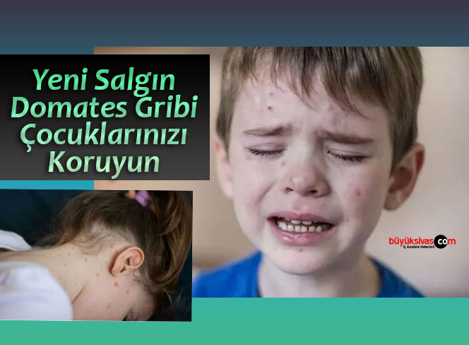 Yeni Salgın Domates Gribi! En çok çocukları vuruyor hızlı bulaşıyor