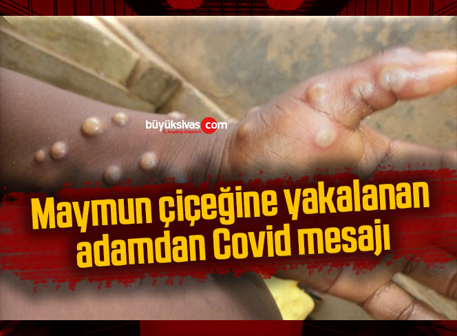 Maymun çiçeğine yakalanan adamdan Covid mesajı