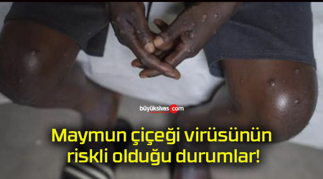 Maymun çiçeği virüsünün riskli olduğu durumlar!