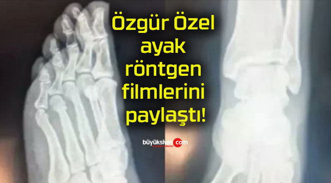 Özgür Özel ayak röntgen filmlerini paylaştı!