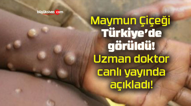 Maymun Çiçeği Türkiye’de görüldü! Uzman doktor canlı yayında açıkladı!