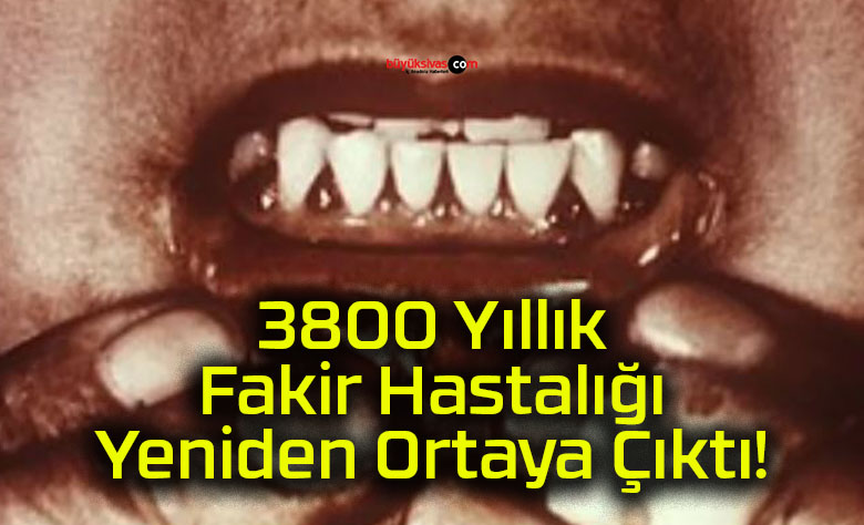 rfakir hastalığı
