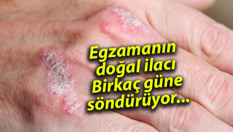 Egzamanın doğal ilacı: Birkaç güne söndürüyor…