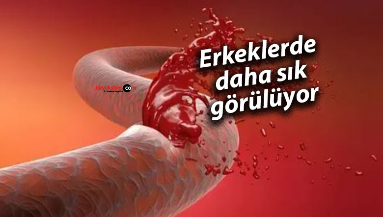 Erkeklerde daha sık görülüyor