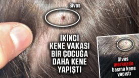 Sivas’ta aynı gün iki ayrı vakada çocukların başına kene yapıştı