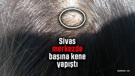 Sivas merkezde kene alarmı: Küçük kızın başına yapıştı, hastaneye kaldırıldı