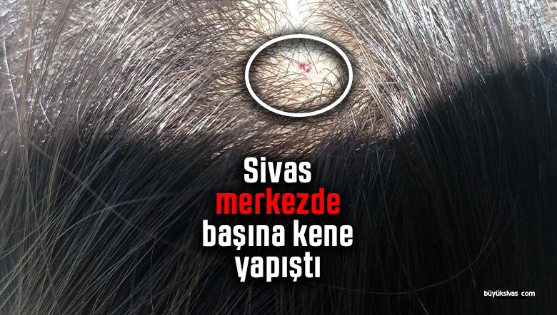 Sivas merkezde kene alarmı: Küçük kızın başına yapıştı, hastaneye kaldırıldı