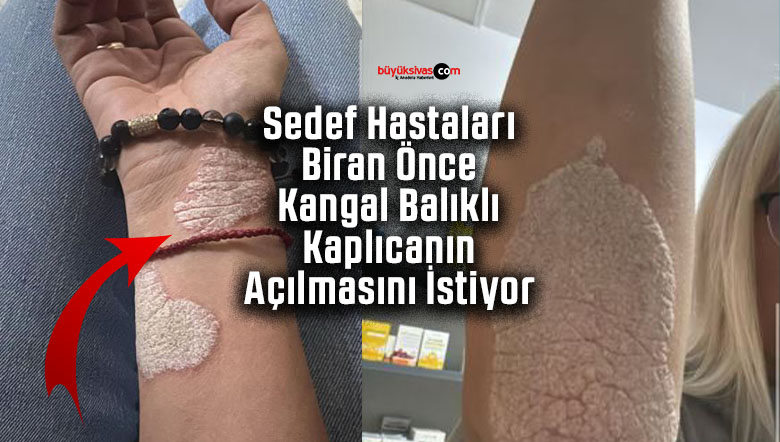 Sedef hastaları isyanda: Sivas Kangal Balıklı Kaplıca aylarca neden kapalı?