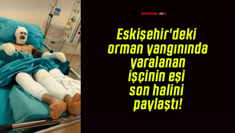 Eskişehir’deki orman yangınında yaralanan işçinin eşi son halini paylaştı!