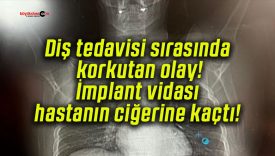 Diş tedavisi sırasında korkutan olay! İmplant vidası hastanın ciğerine kaçtı!
